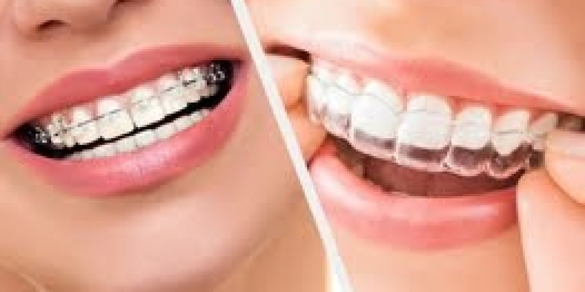 Braces That Shine: Why Choosing the Best Dentist for Braces in Bangalore Matters for Your Smile